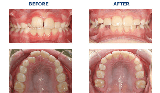 Orthodontic-Treatment